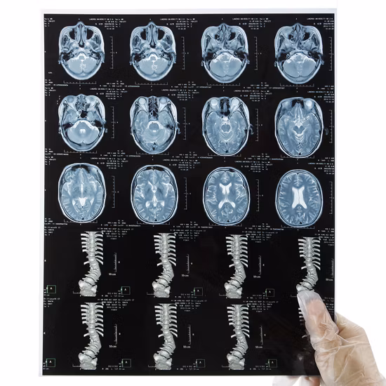 Medical Dry X Ray Film for Hospitals in China