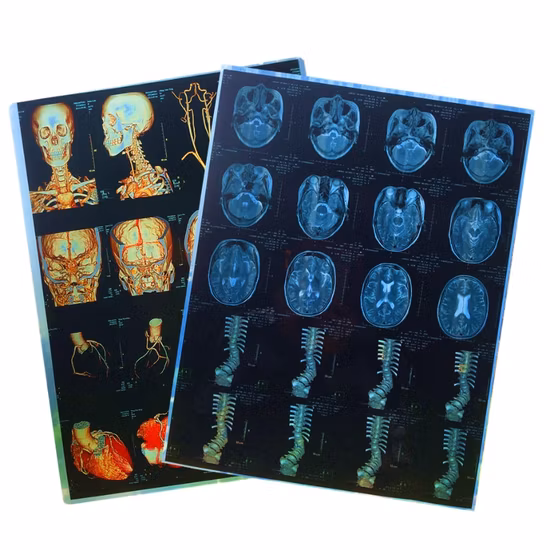Medical Dry X Ray Film for Hospitals in China
