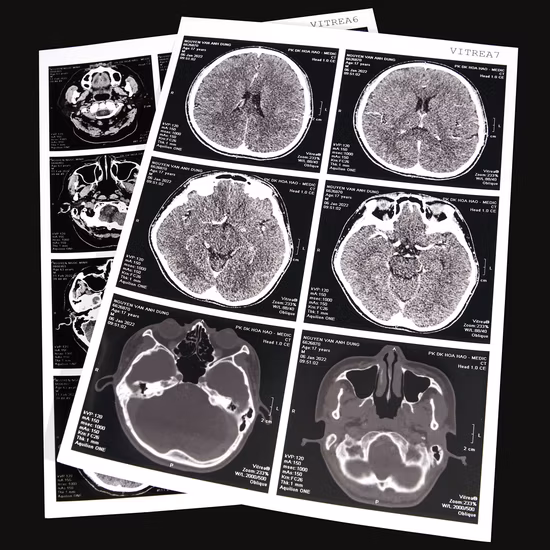 Medical Dry X Ray Film for Hospitals in China