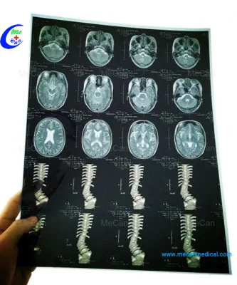 Radiology Medical Dry Inkjet X Ray Film for Hospital Film Printer