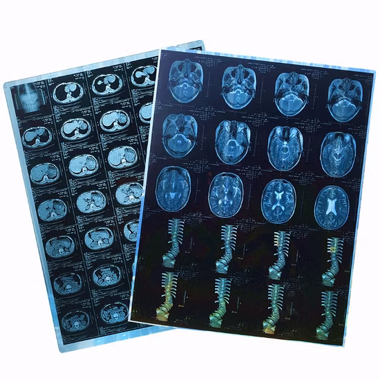 Medical Dry X Ray Film for Hospitals in China
